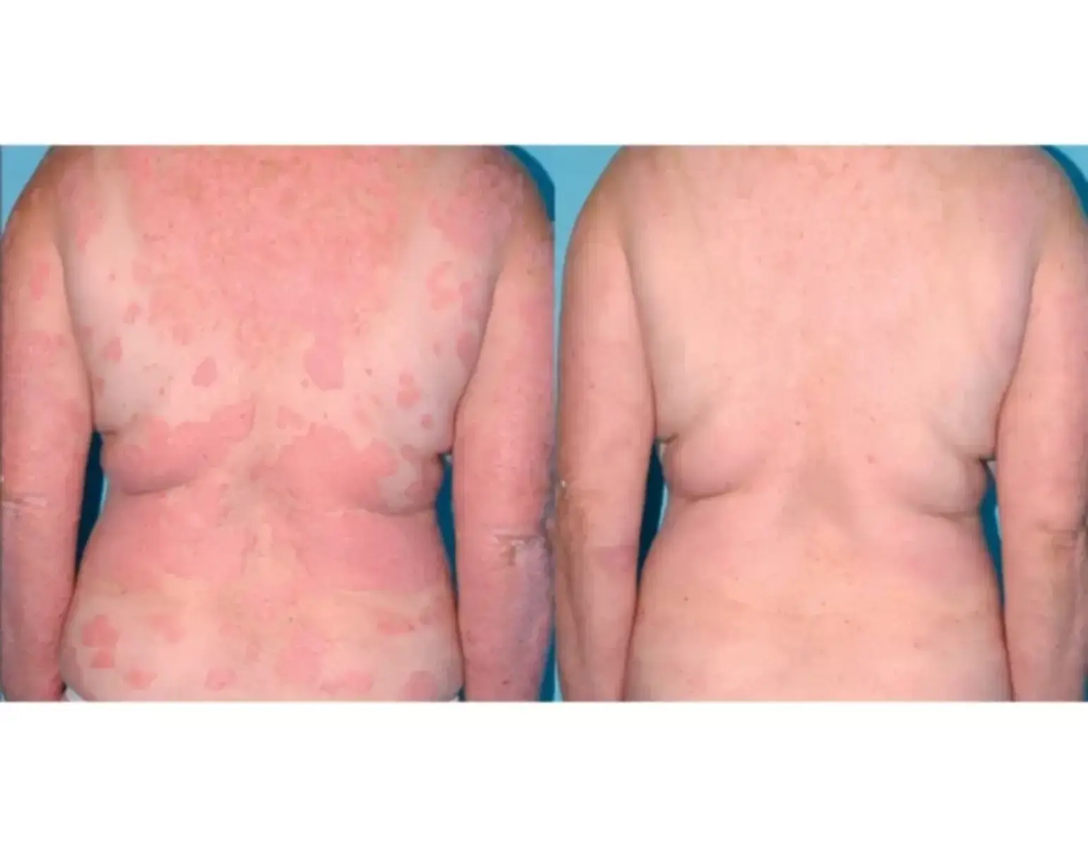 pacient mulțumit după tratament dermatologic