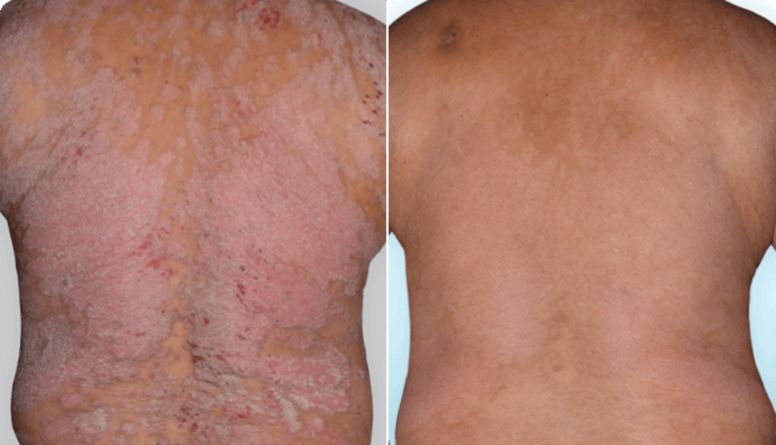 tratament dermatologic cu petrol naftalanic